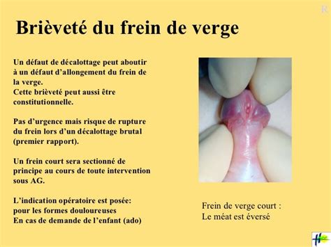 rupture du frein du prepuce|Rupture du frein : description, cicatrisation et conduite。